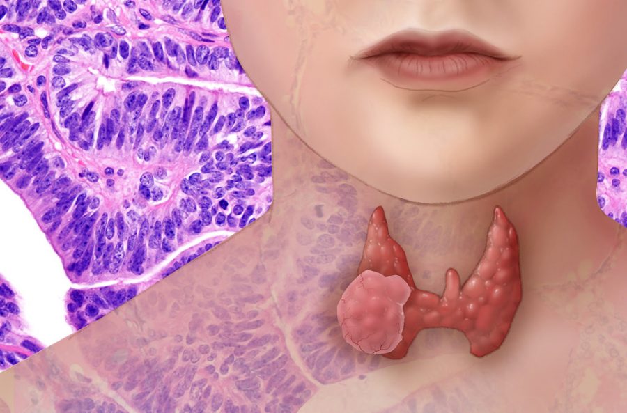 While thyroid cancer is very treatable with surgery and other therapies, it remains the fastest growing cancer in the United States.